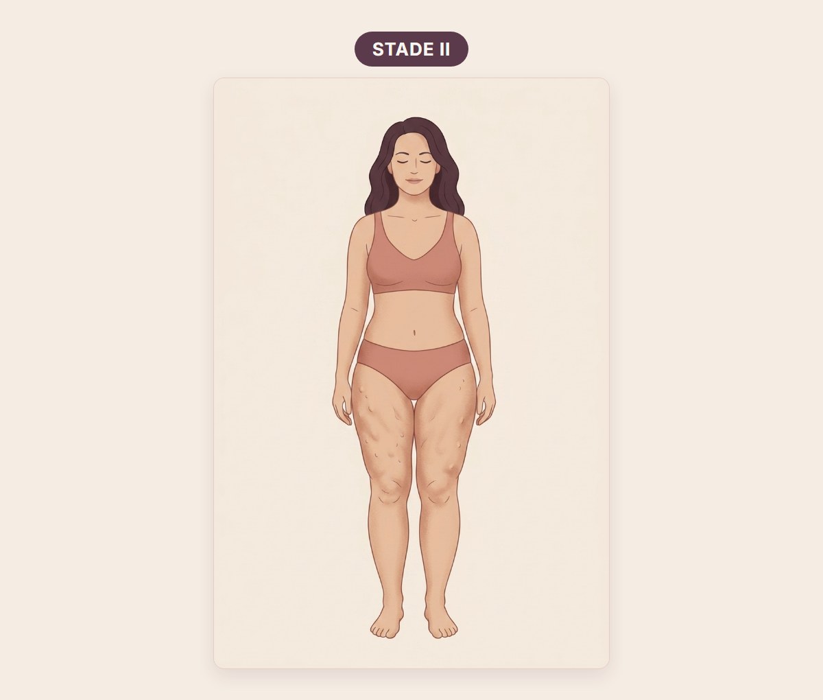 Morphotype du stade 2 du lipœdème : silhouette entière avec une surface de peau irrégulière et capitonnée sur les cuisses, pieds toujours fins