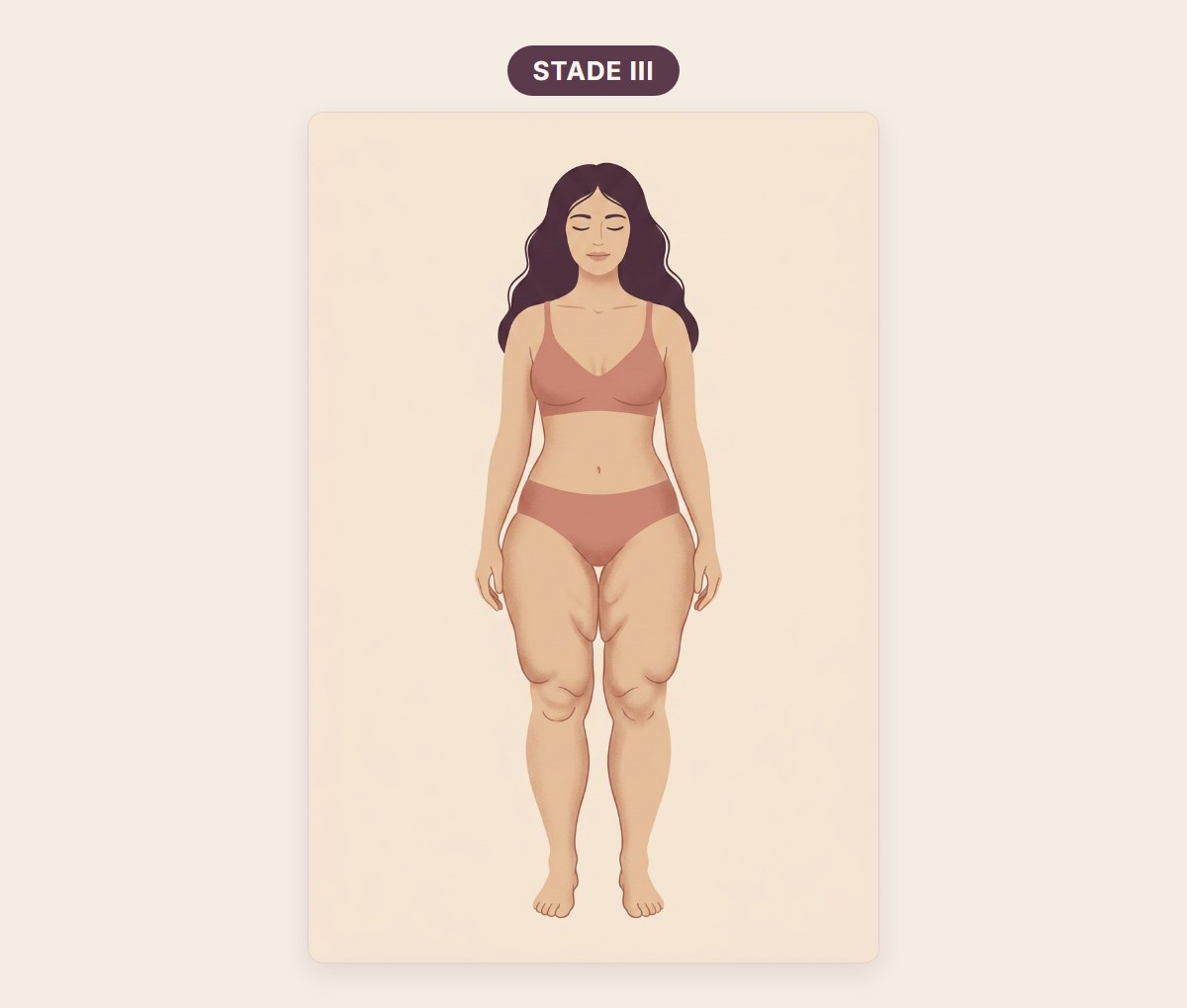Morphotype du stade 3 du lipœdème : silhouette entière avec des volumes importants et des contours de jambes déformés par des plis, pieds épargnés