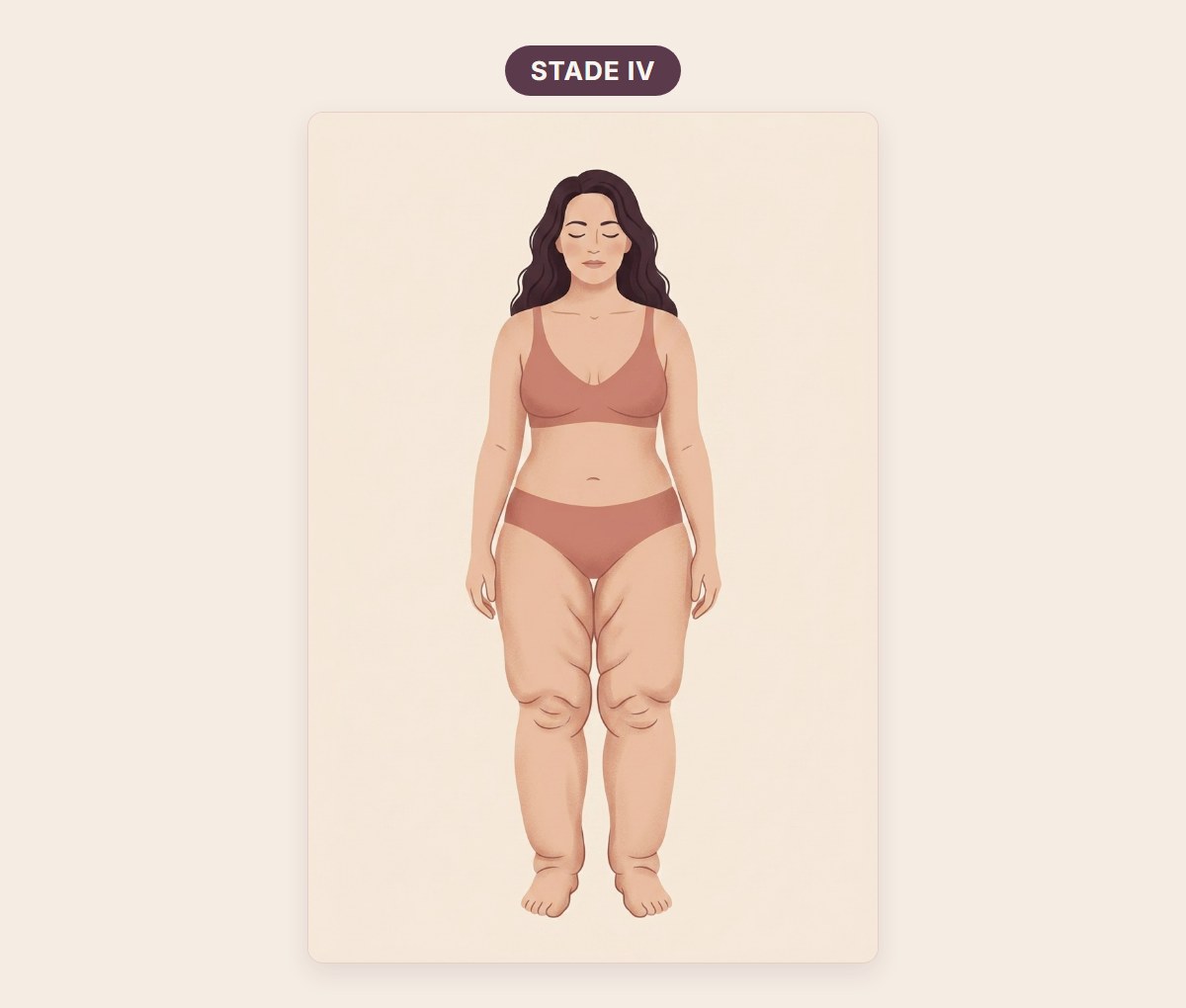 Morphotype du stade 4 du lipœdème, le lipo-lymphœdème : silhouette entière avec des jambes très volumineuses et un gonflement qui atteint les chevilles et les pieds